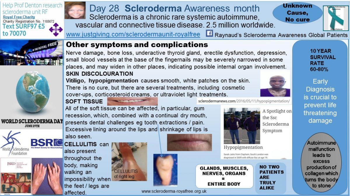 DAY 28 Scleroderma Awareness Month Complications Skin Discoloration