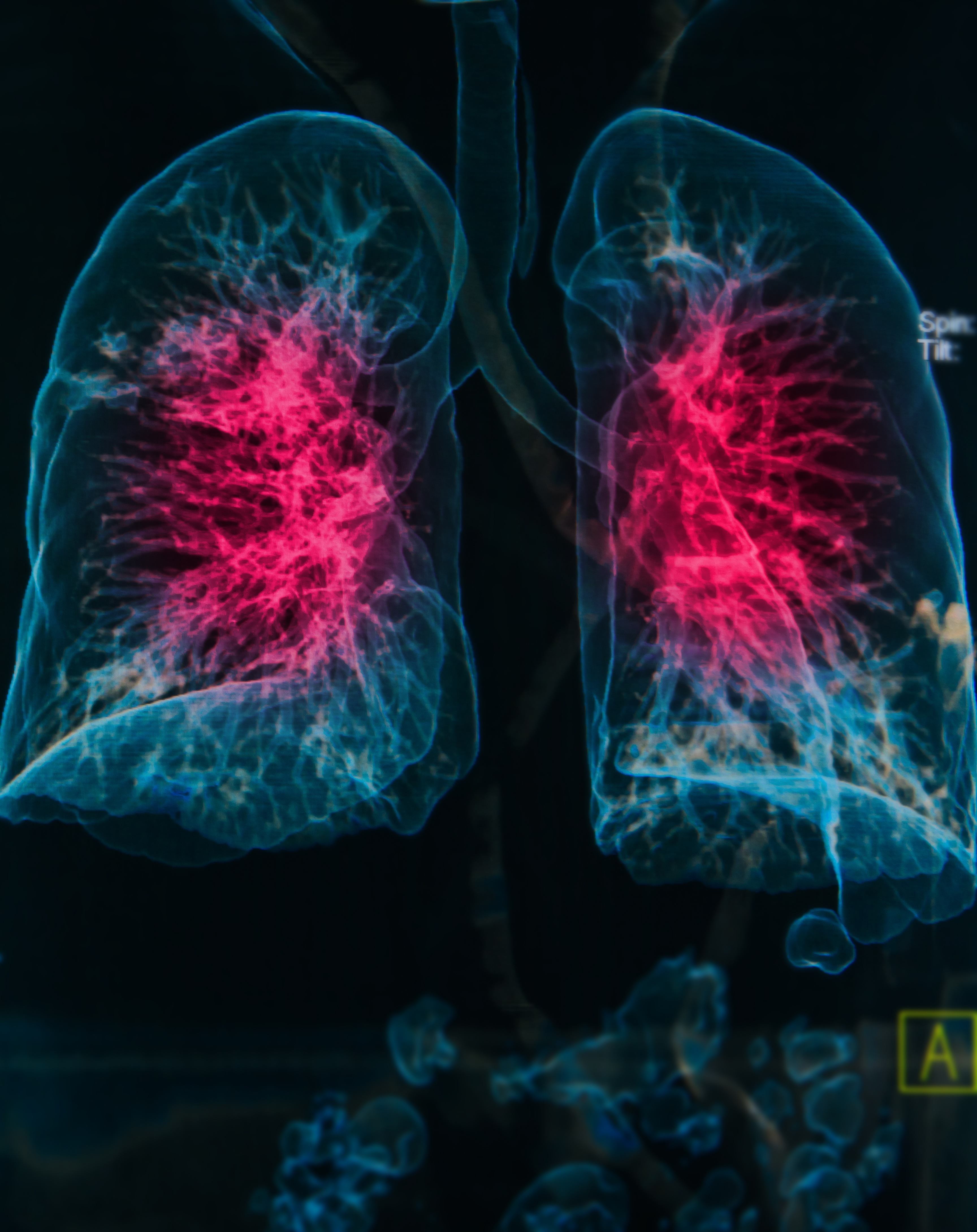 Scleroderma and interstitial lung disease