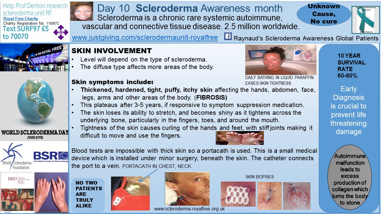 Day 10 Scleroderma Awareness month