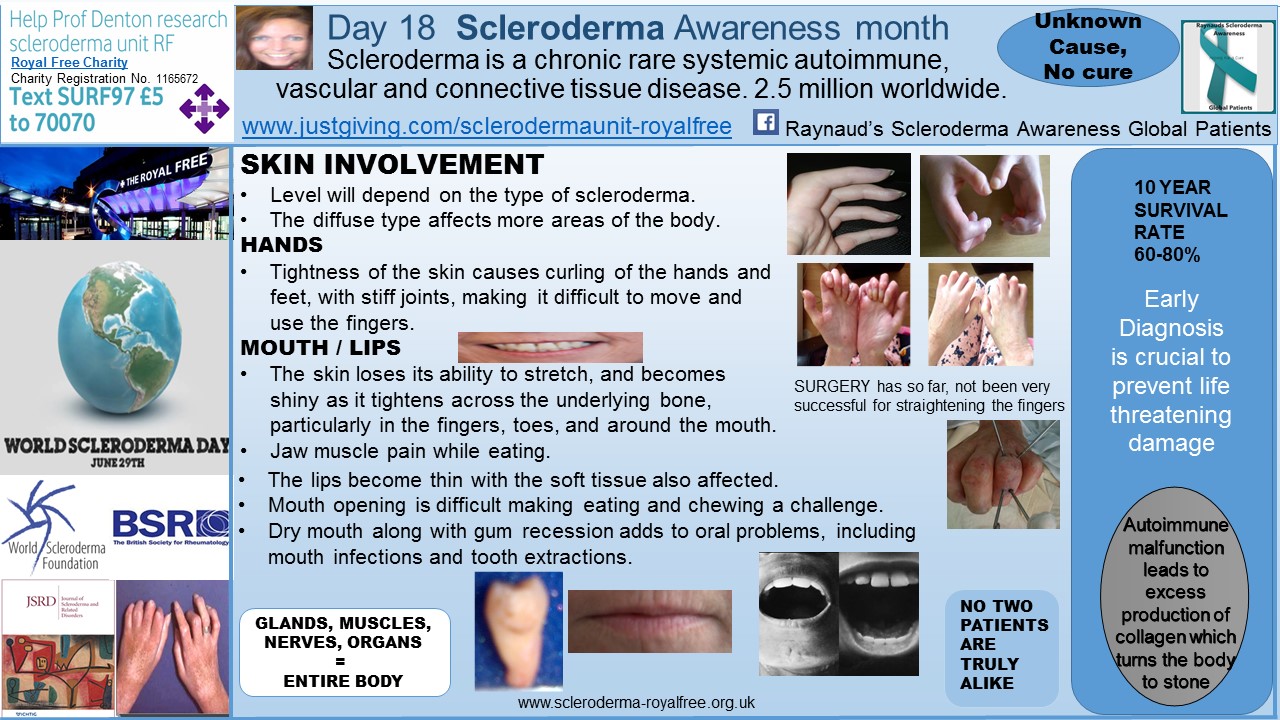 Day 18 Scleroderma Awareness month