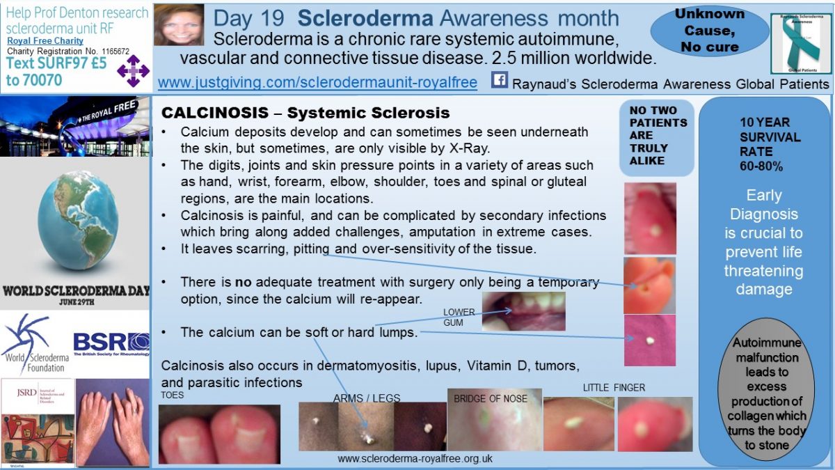 calcinosis on nose