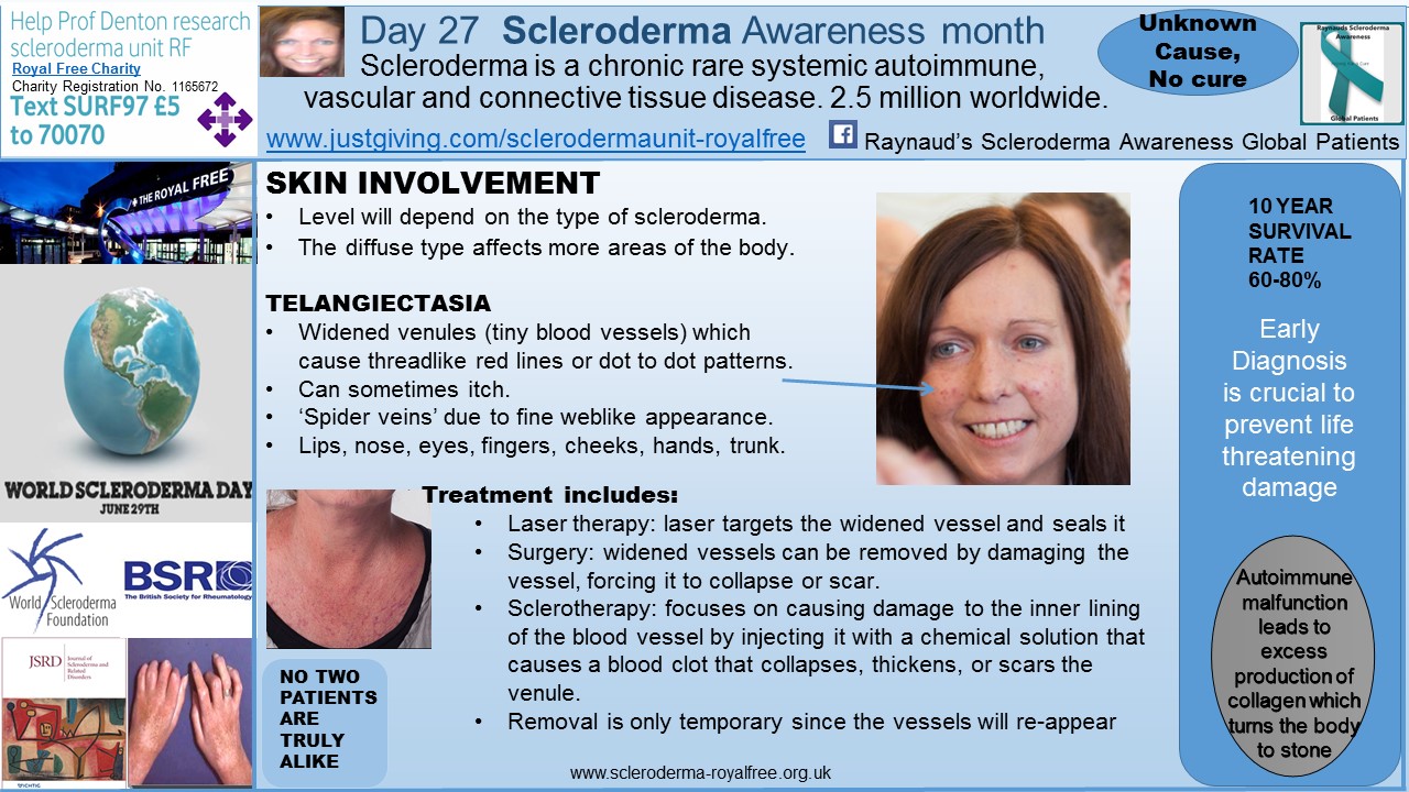 Day 27 Scleroderma Awareness month