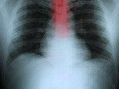 Sine Sclerosis