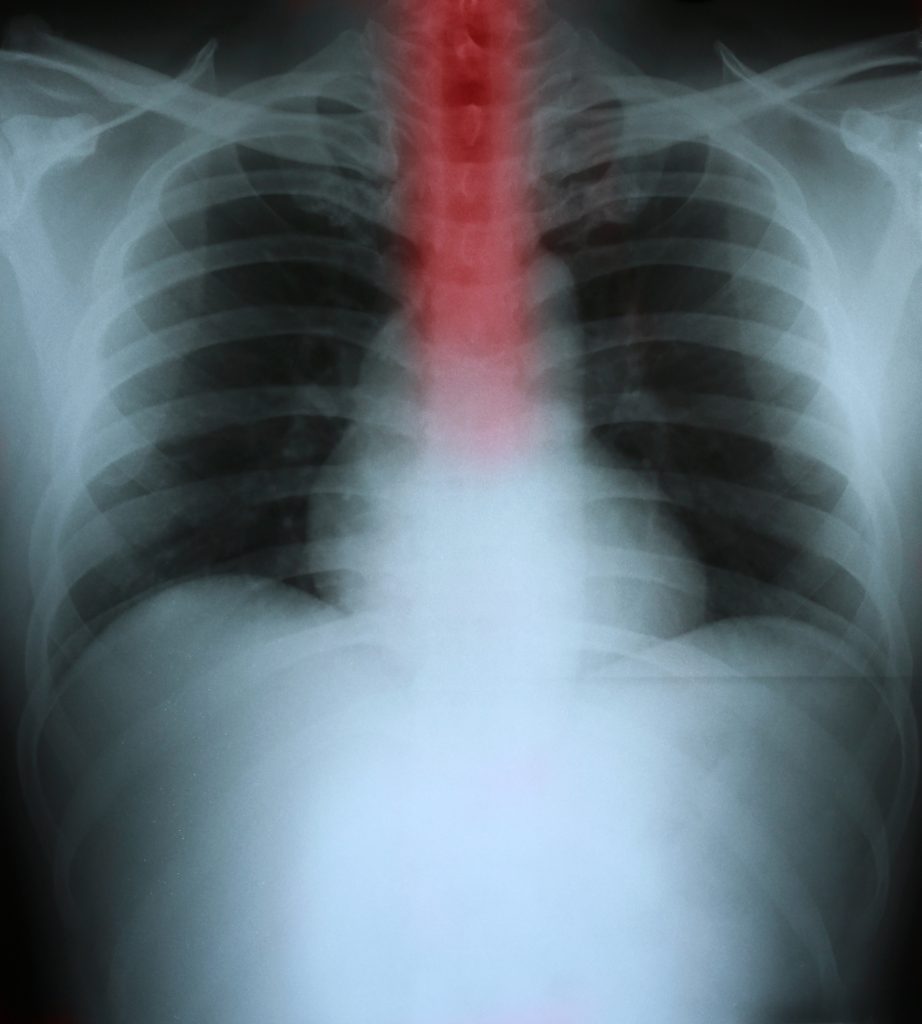 �Classic Scleroderma Esophagus� Seen in of �Classic Scleroderma Esophagus� Seen in of