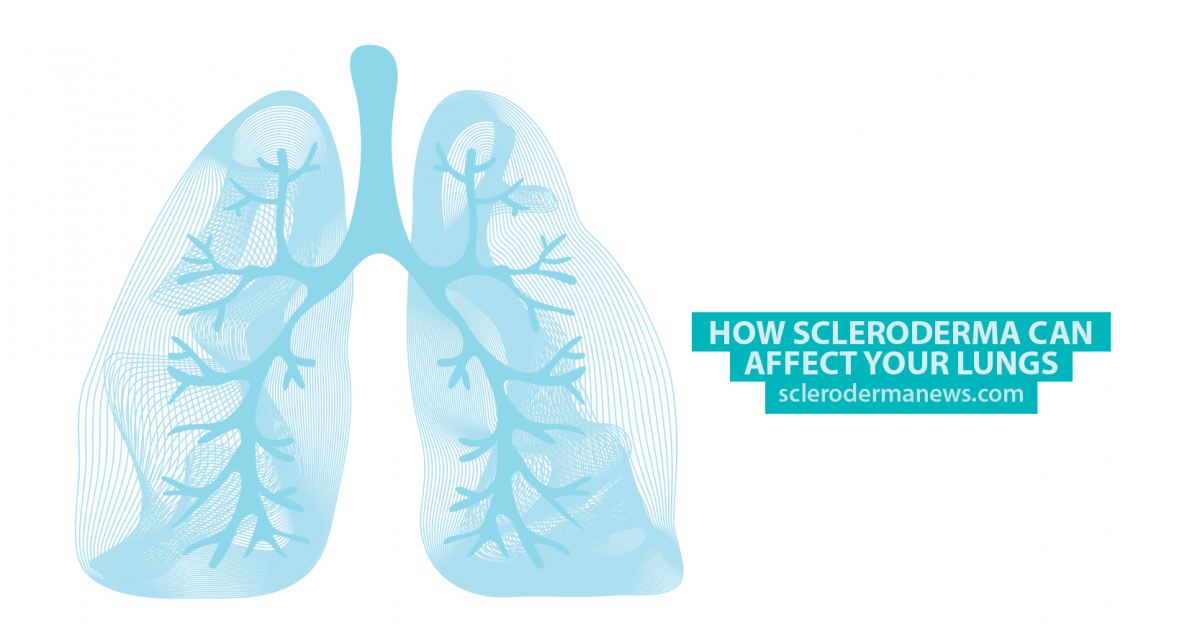 How Scleroderma Can Affect Your Lungs Scleroderma News