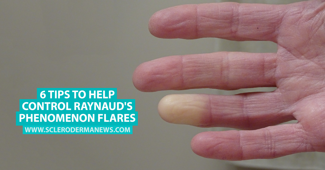6 Tips To Help Control Raynauds Phenomenon Flares Scleroderma News
