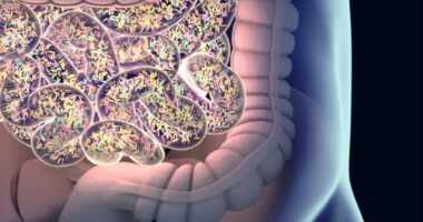 bowel perforation