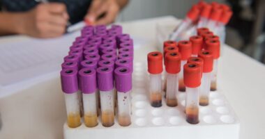 COVID-19 vaccines | Scleroderma News | Vials of blood on display in laboratory