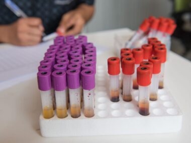 COVID-19 vaccines | Scleroderma News | Vials of blood on display in laboratory