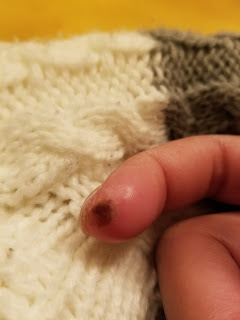 finger ulcer | Scleroderma News | Lisa Weber shows the small ulcer that occurred on the tip of her pointer finger
