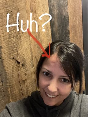 forehead dent | Scleroderma News | Lisa smiles and takes a selfie to show the thumbprint-sized indentation on her forehead. She has drawn an arrow pointing to the dent and added text to the image that says, "Huh?" 